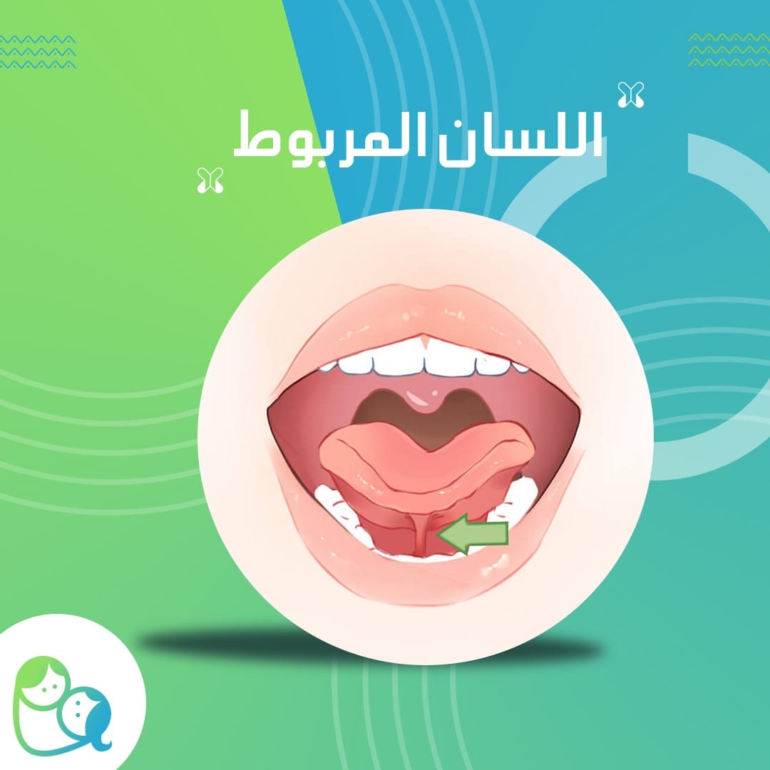 التصاق اللسان (اللسان المربوط) - الأعراض والأسباب - د. أسامة عبد العظيم
