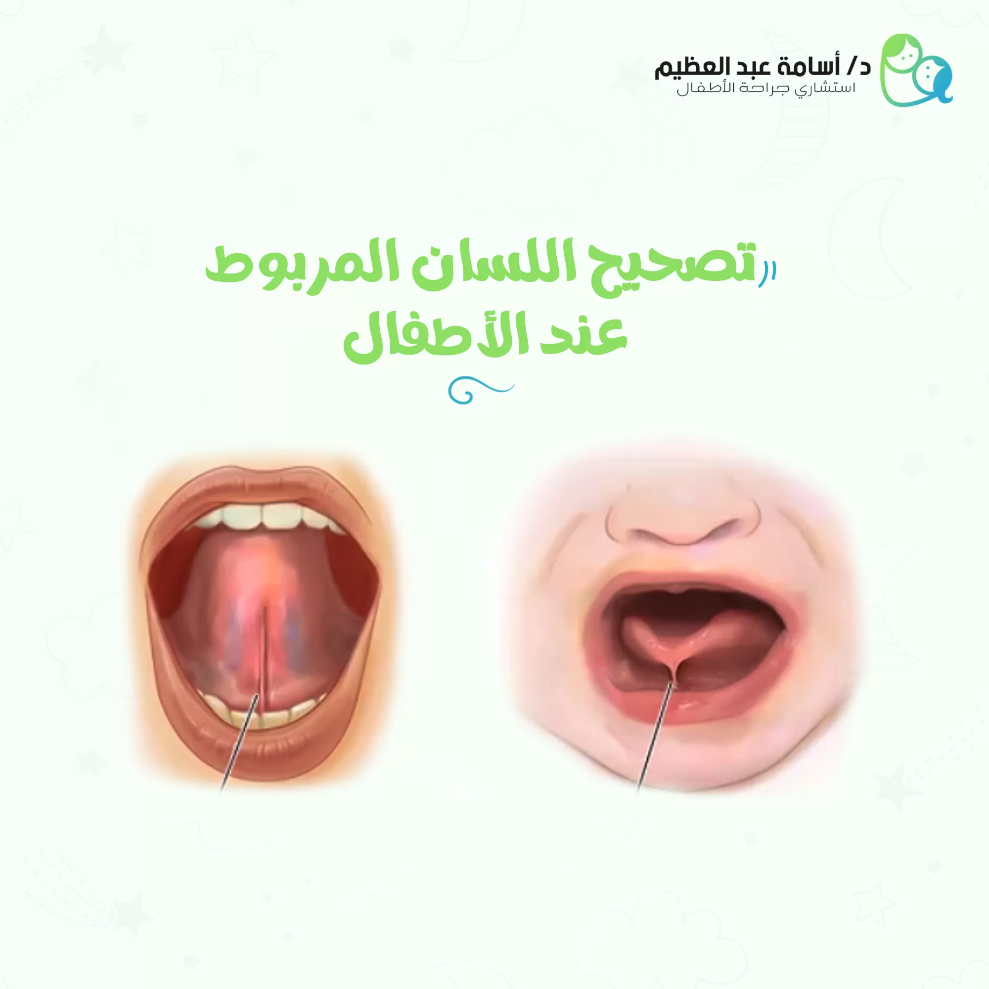 تصحيح اللسان المربوط لدى الأطفال التشخيص والعلاج - د. أسامة عبد العظيم